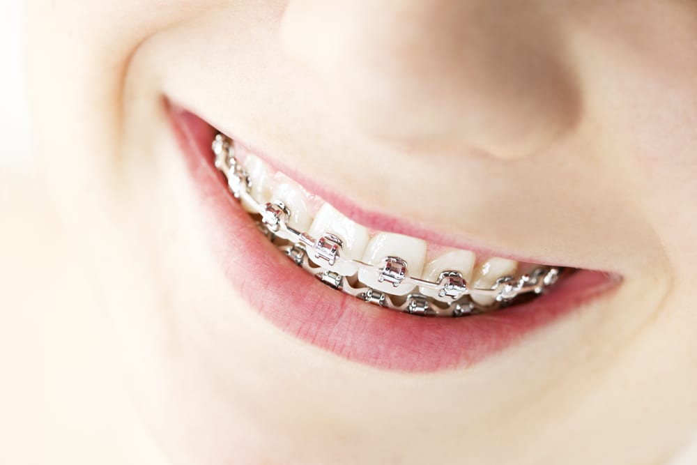Braces on the teeth close up. The wire on the brackets has bent Stock Photo
